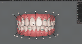 ClinCheck Treatment Planning